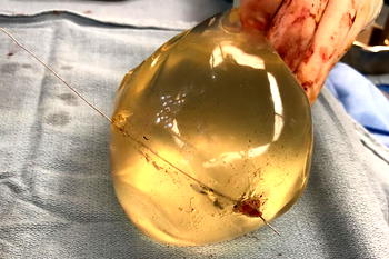 Woman’s breast implants deflect bullet, save her life