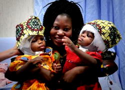Two conjoined twins separated successfully in Italy