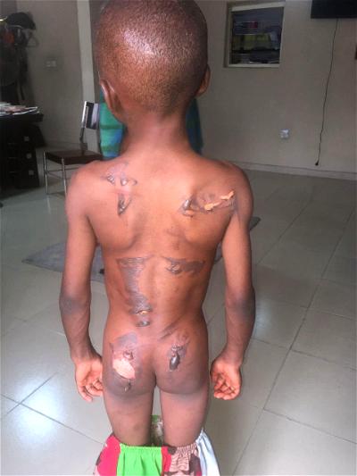 Woman burns 8-year-old nephew's buttocks, back over N50 groundnut