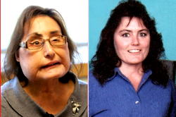 First US recipient of partial face transplant dead at 57