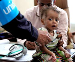 Half of Yemen under-5s face acute malnutrition: UN
