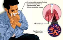 Breaking: TB kills 18 persons per hour in Nigeria – Report