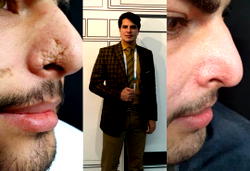 Dr Amir Feily Non-Surgical Approach as a New and Effective Treatment for Defected Scars