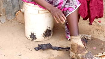 Years after: Victims of Bauchi snakebite cry out, with no help in sight; poverty bites