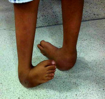 About 100,000 Nigerians suffer clubfoot yearly ― NOA