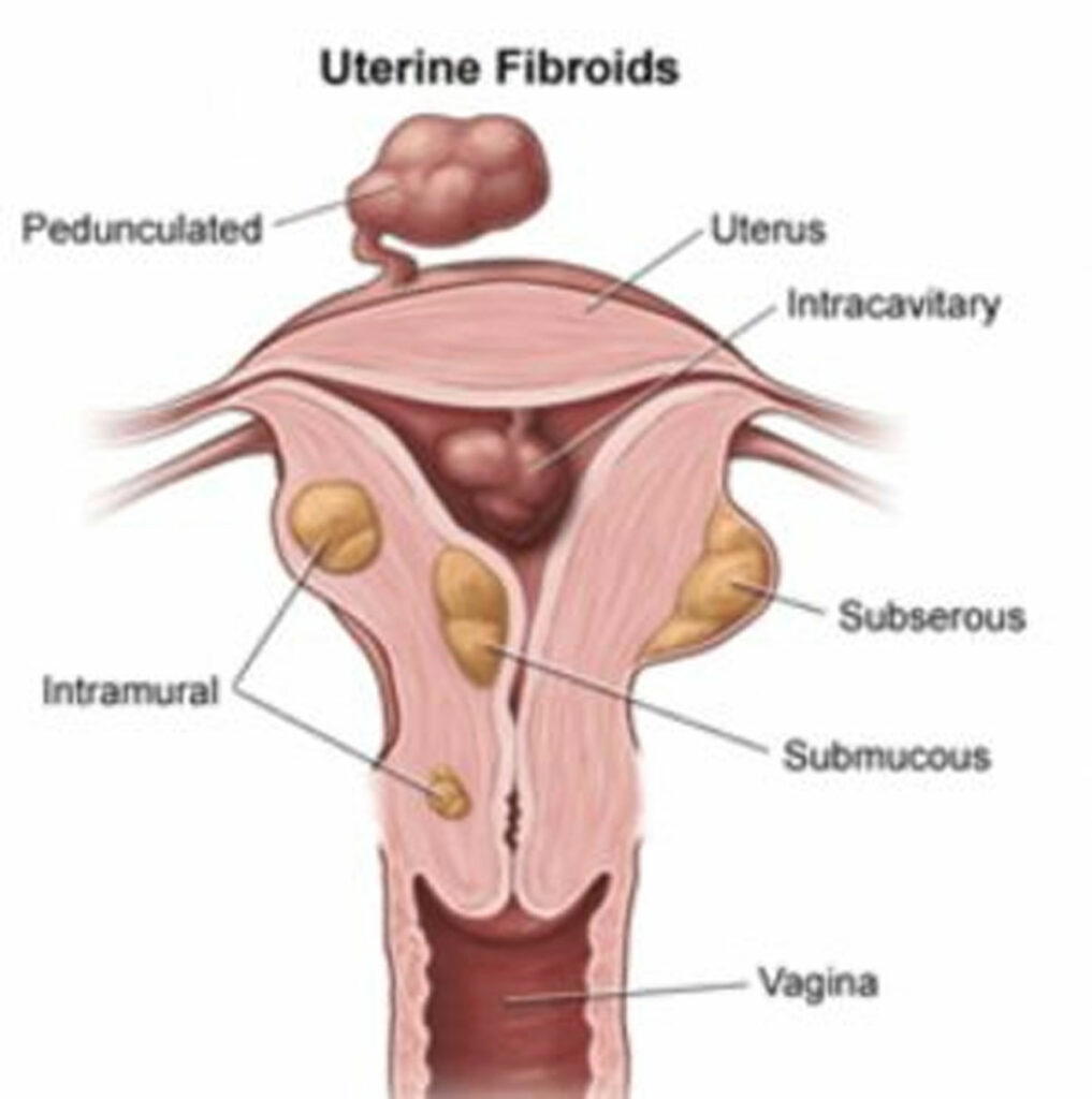Fibroid treatment