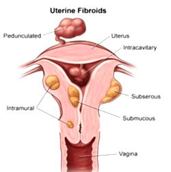 HIFU fibroid removal technology: Nigerian women share experiences