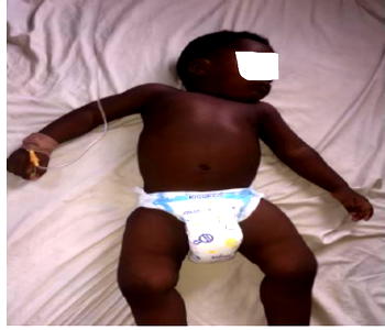 Help! Baby Timileyin needs N200,000 to offset surgery bills
