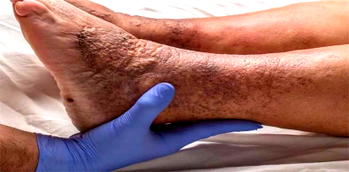200,000 Nigerians die of thrombosis annually – Expert