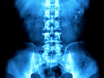 Stephanie, scoliosis patient seeks N10m for corrective surgery