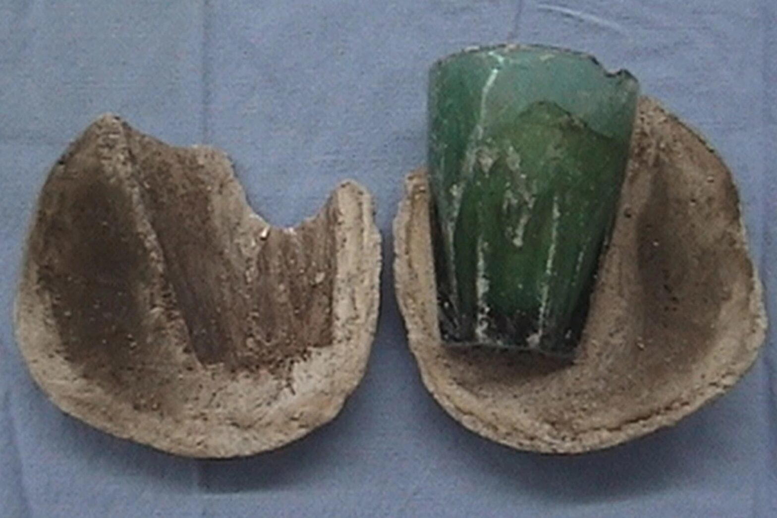 Glass tumbler found in woman's bladder 4 years after she used it as s3x toy