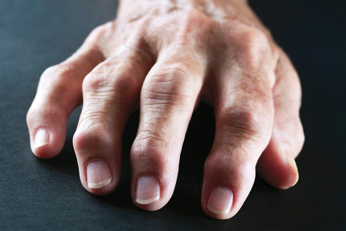 Experts call for awareness, early diagnosis of rheumatoid arthritis ...