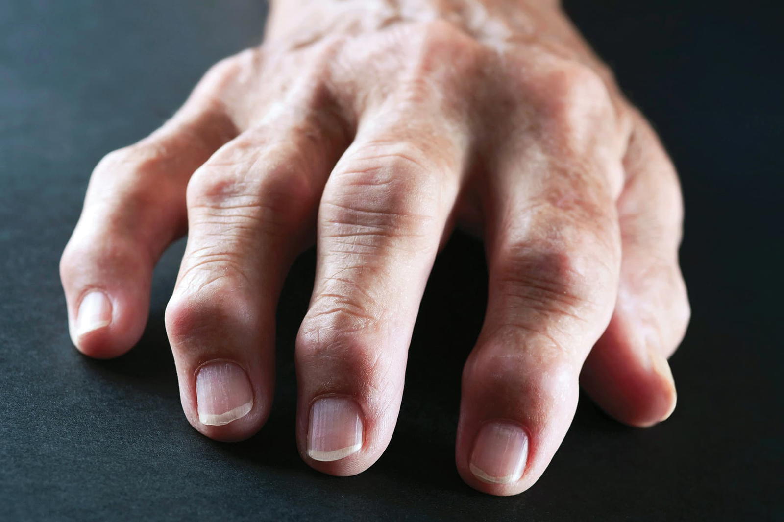 váll rheumatoid arthritis)