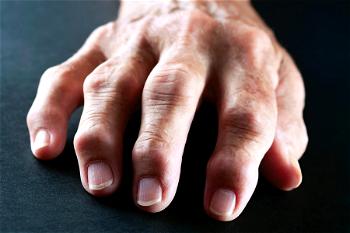 Experts call for awareness, early diagnosis of rheumatoid arthritis