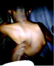 Boy, 12 seeks N11m for urgent spinal fusion surgery