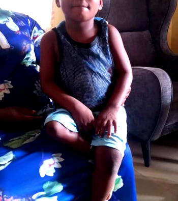 UNIMEDTH, Tola Awosika Foundation restore hope of 6-year-old burn survivor