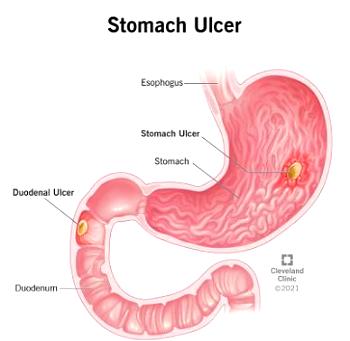 Why stomach ulcers persist among Nigerians — Prof Stella Smith