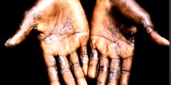 Nigeria records eight deaths from 789 cases of mpox