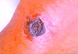 Ponmo: What you should know about Anthrax