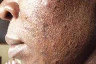 dangerous skin diseases