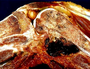 Experts worry over increasing rate of bone cancers in Nigeria