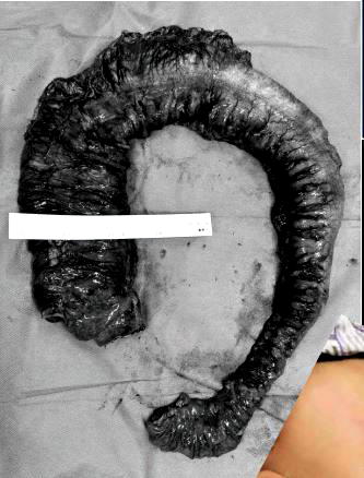 Surgeons remove 3ft python-shaped poo from constipated woman