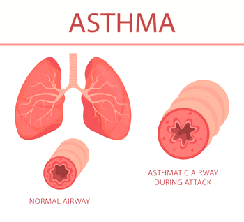 Be vigilant in diagnosing asthma from other ailments – Expert warns