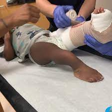 Brittle bone disease