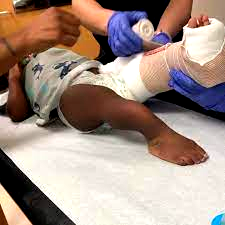 Brittle bone disease is not witchcraft, as OIF urges support for sufferers