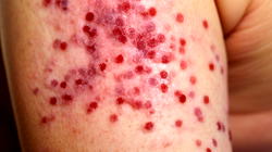 What to know about Leukemia