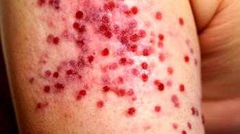 What to know about Leukemia