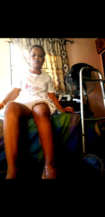 33yr-old Omolola seeks N3.5m for another bone corrective surgery