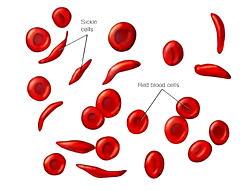 New SCD treatments approved