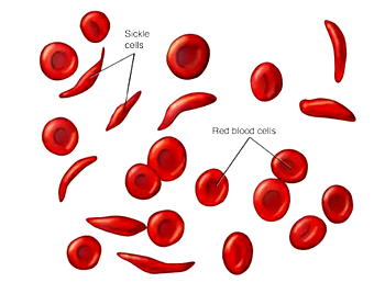 New SCD treatments approved