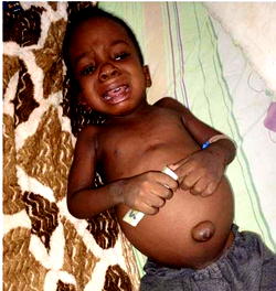 2-year-old needs N3.7m for Leukemia treatment