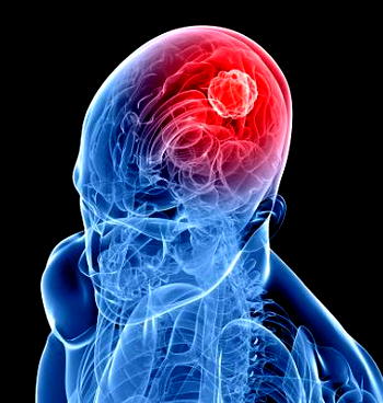 World-first treatment saves man from deadly brain cancer