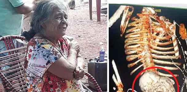 Woman dies after surgery to remove dead foetus she carried for 56 years