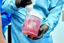Organ shortage: Surgeons are saving human lives with pig kidneys