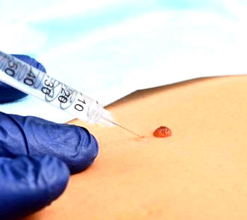 ACPN petitions FG over mandatory use of local needles, syringes in hospitals
