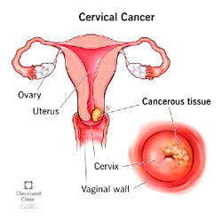 Nigeria records 7,968 deaths from cervical cancer yearly, experts raise alarm