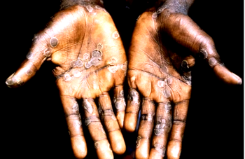 Concerted action against Mpox global emergency
