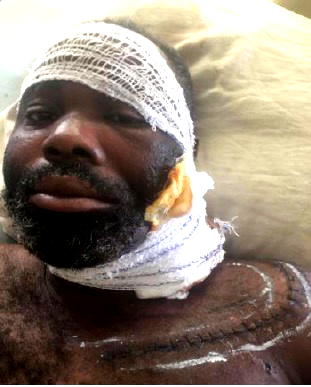 Patient blames UCH for irreversible blindness after radiotherapy