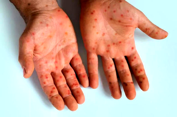 1,100 mpox deaths recorded across Africa – CDC