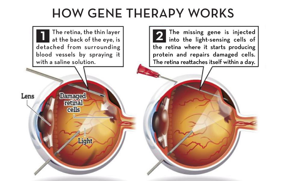 Gene therapy offers hope for patients with rare vision loss