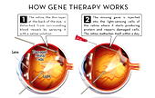 Gene therapy offers hope for patients with rare vision loss