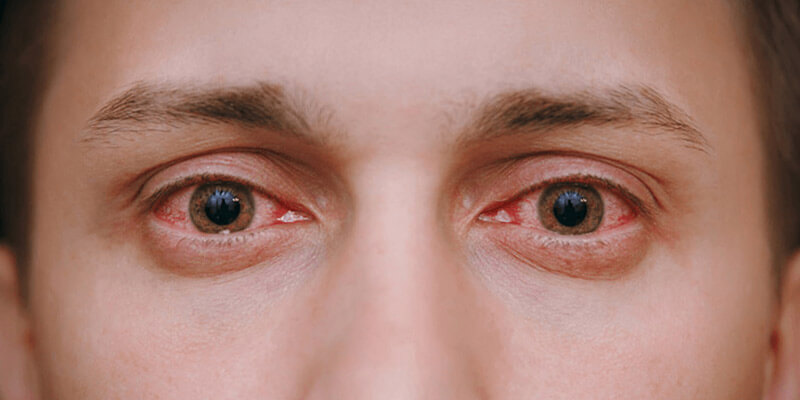 What the colour of your eyes says about your health