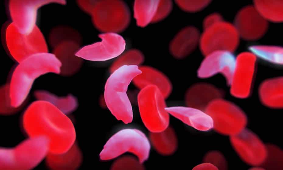 Nigeria’s Hidden Health Crisis: Transforming Sickle Cell Disease Management with Innovation and Evidence-Based Solutions
