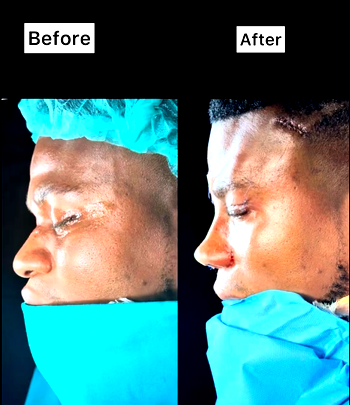 Nose surgery: ‘Some people want it to look bad’ – Comedian Zicsaloma reacts to criticism