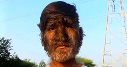 Indian boy with 95 per cent of face covered in hair sets Guinness World Record