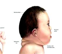 Down Syndrome: Experts call for greater inclusion, empowerment of affected persons